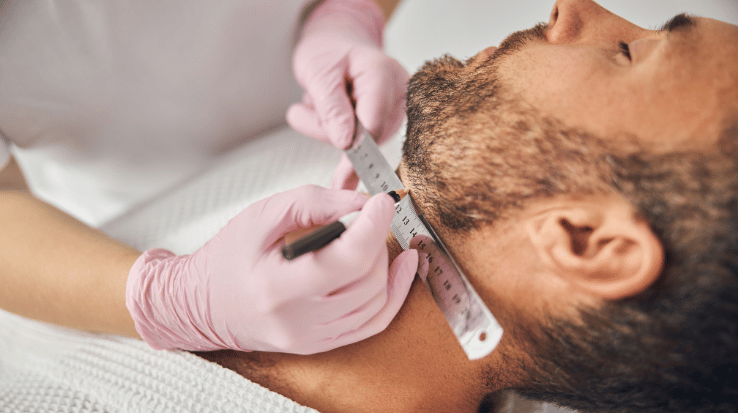 Beard Transplant